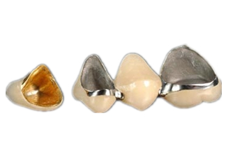 PFM Porcelain Fused Metal Dental Crowns & Bridges