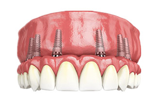 Dental Implants & Surgical Guides