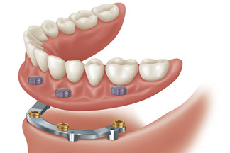 Dental Implants & Surgical Guides